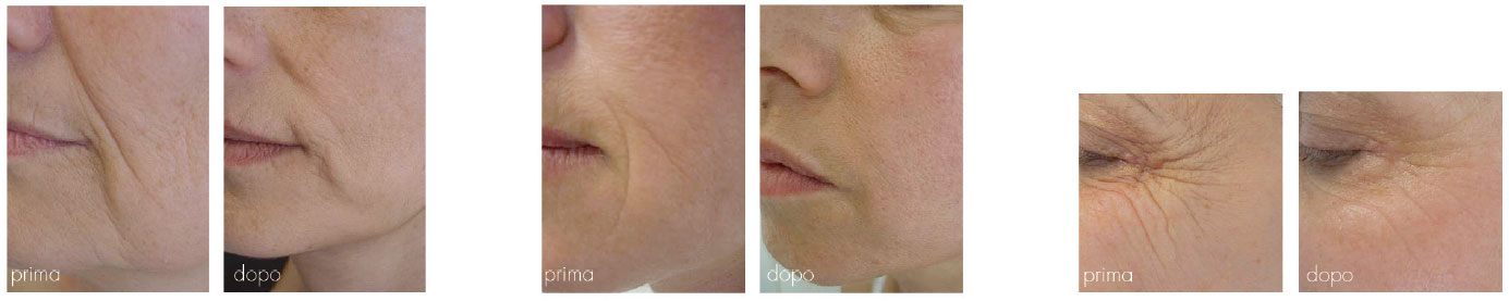 Endospheres Therapy Gesicht